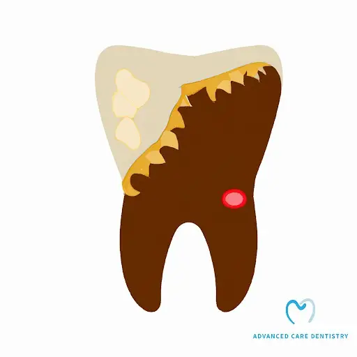 Laser Teeth Whitening