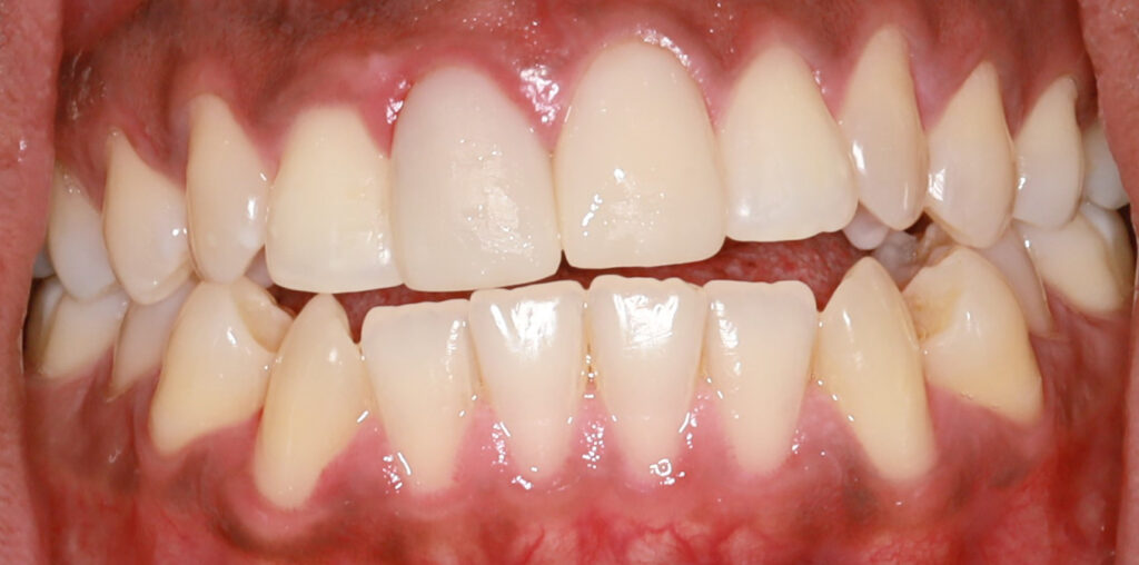 AFTER-4-MONTH-FRONT12-1-crowns(#8,#9)-resize