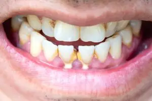 Yellow calculus on lower front teeth