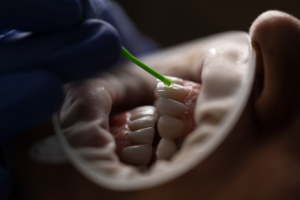 Dental procedure with tool on patient's teeth.
