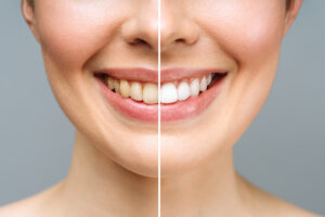 Split smile showing dramatic whitening