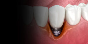 Dental implant with surrounding teeth illustration.