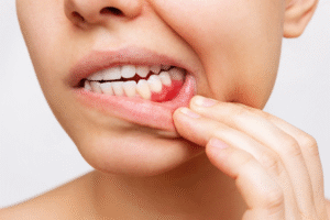 Person showing swollen red gum with fingers.