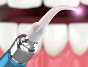 Dental laser tool in front of teeth.