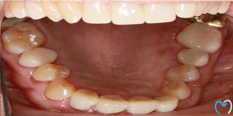 Close-up of the lower teeth and gums inside an open mouth.