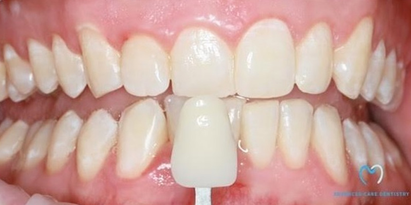 Close-up of teeth with a dental shade guide for color matching.