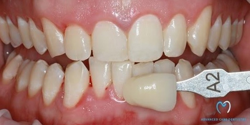 A teeth shade guide being compared to natural teeth.