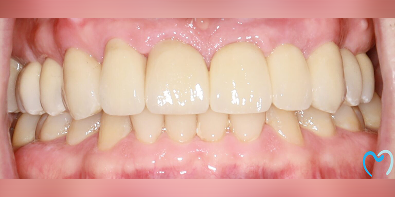 Close-up of healthy upper and lower teeth and gums.