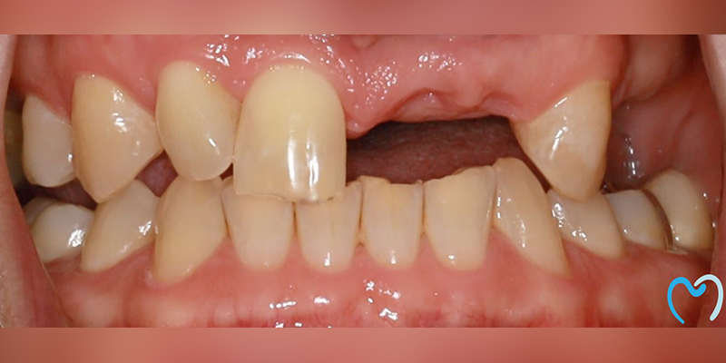 Close-up of a mouth missing an upper front tooth.