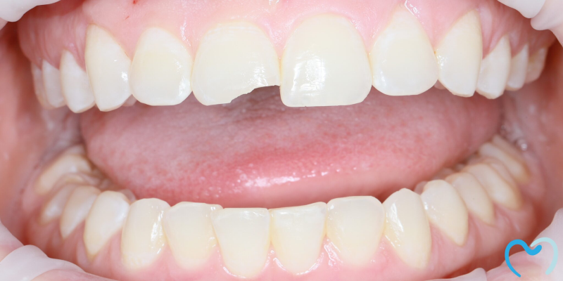 Close-up of a chipped front tooth showing dental damage.