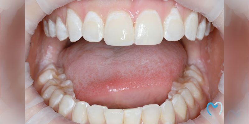 Close-up of open mouth showing upper and lower teeth and tongue.