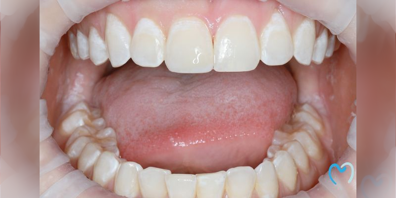 Close-up of open mouth showing upper and lower teeth and tongue.