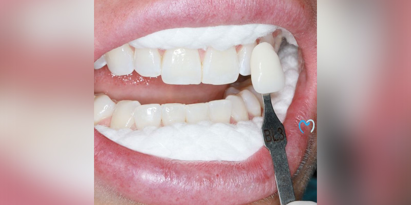 A dental professional applying a teeth whitening tray to a patient's teeth.