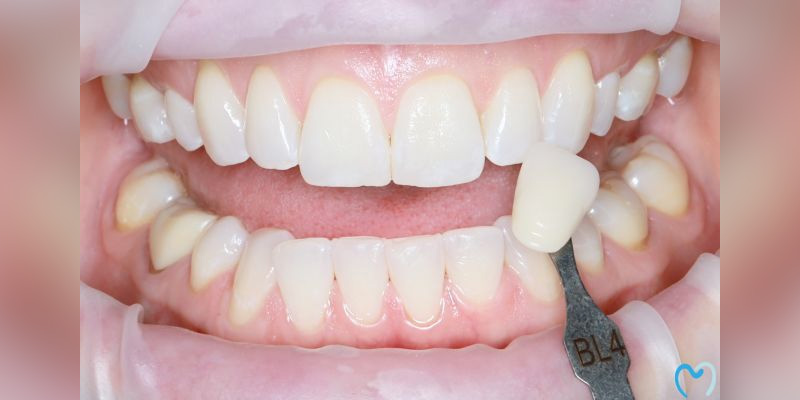 Dental shade matching for teeth restoration.