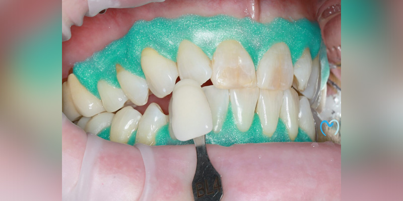 Dental procedure matching tooth shade with a dental shade guide.