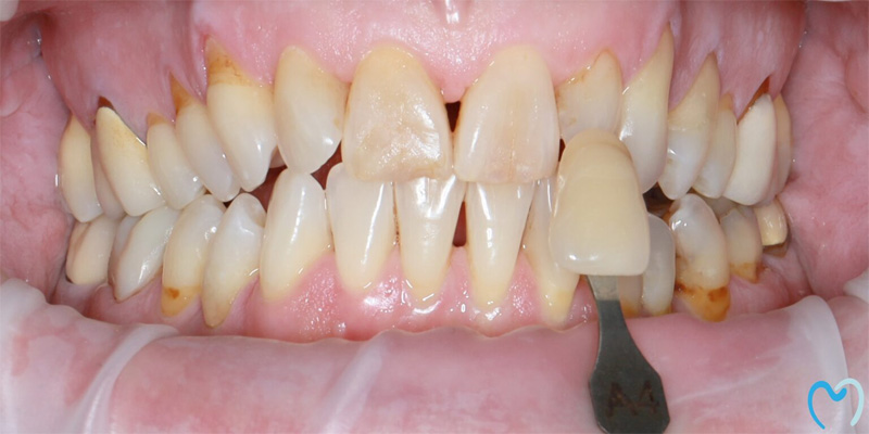 Close-up of teeth with dental discoloration and gaps.