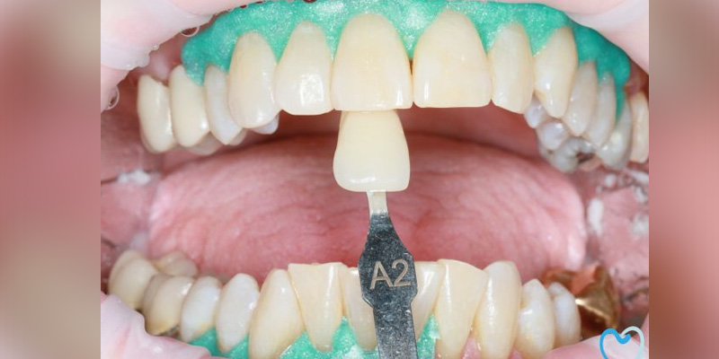 Dental shade matching for tooth restoration using shade guide A2.