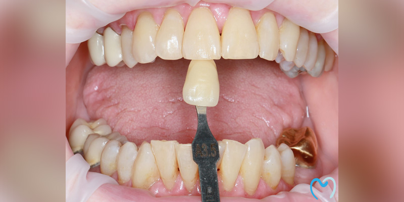 Tooth shade matching for dental restoration.