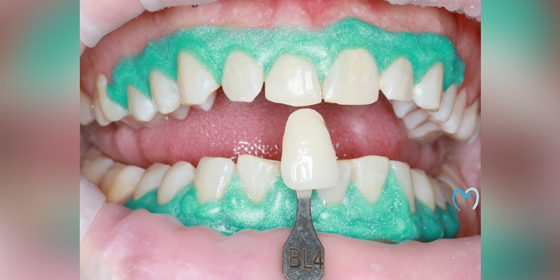 Teeth whitening treatment with shade matching in progress.