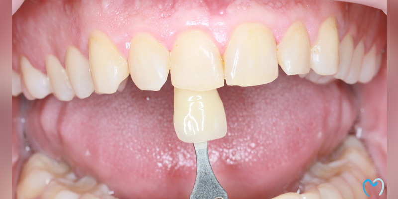 A dental shade guide matching a tooth color.