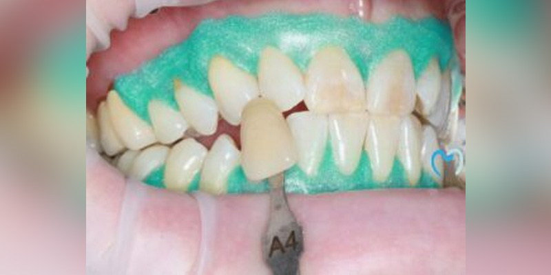 Shade matching for dental restoration using a shade guide.