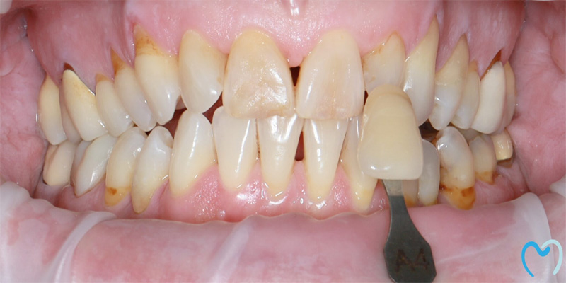 Close-up of teeth with dental shade guide for color matching.