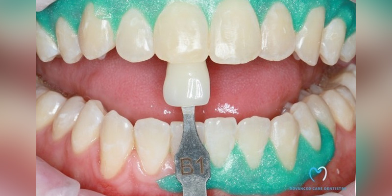 Shade matching for dental restoration with a shade guide.