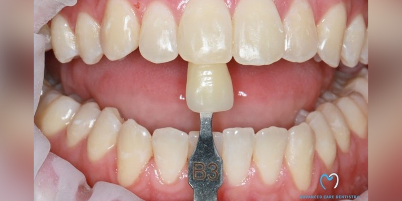 A dental shade guide being used to match teeth color.