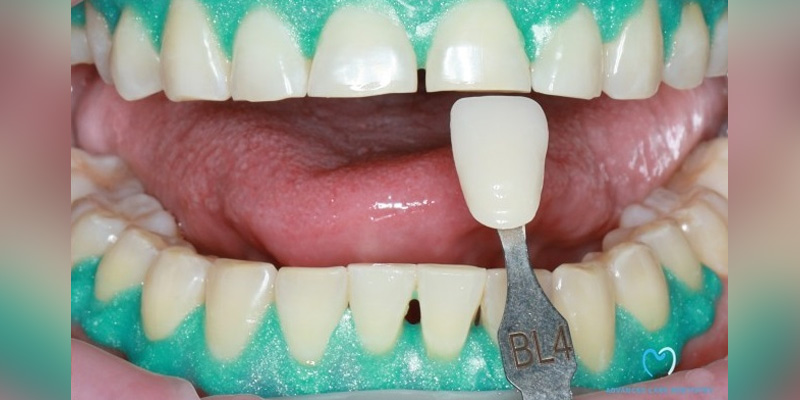 Close-up of teeth color matching for dental restoration.
