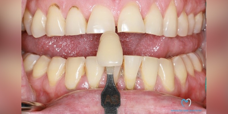 Shade matching for dental restoration on front teeth.