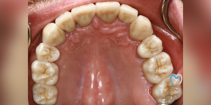 Close-up of upper teeth and palate inside a mouth.