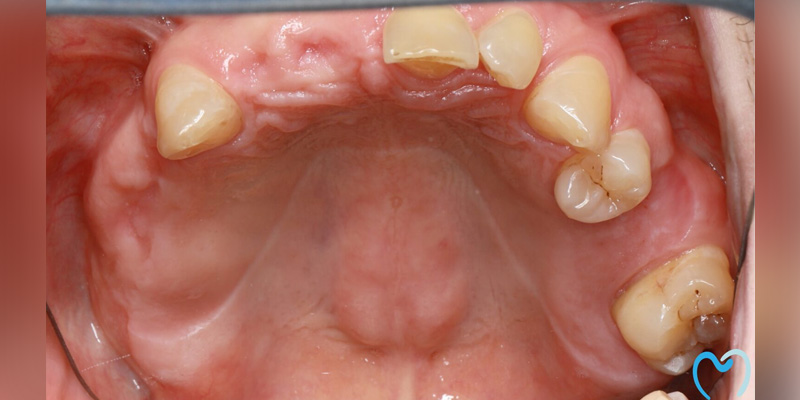 Upper jaw with missing and damaged teeth.
