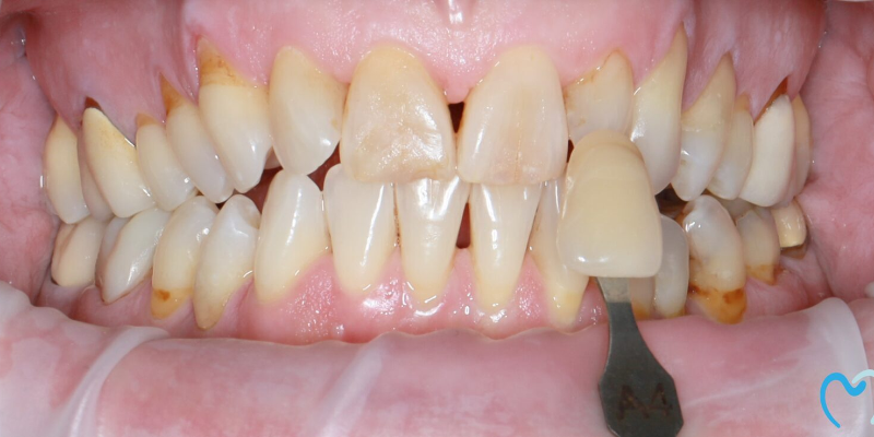 Close-up of stained and worn lower front teeth with dental tool.