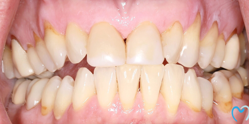 Close-up of human teeth showing some discoloration and plaque buildup.