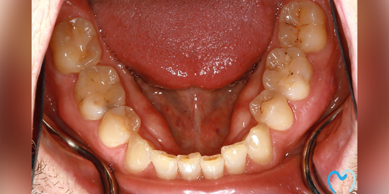 Close-up of lower teeth with dental wear and tongue visible.
