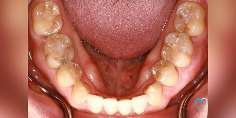 Close-up of lower teeth and tongue inside the mouth.
