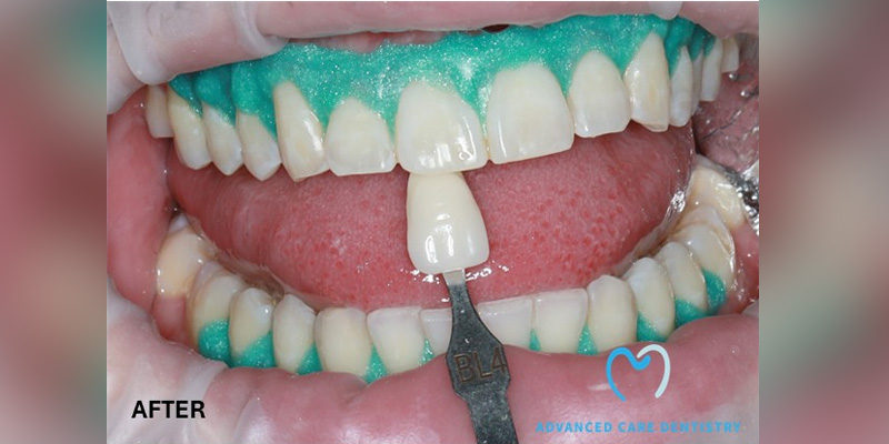 Dental shade matching using a shade guide next to teeth.