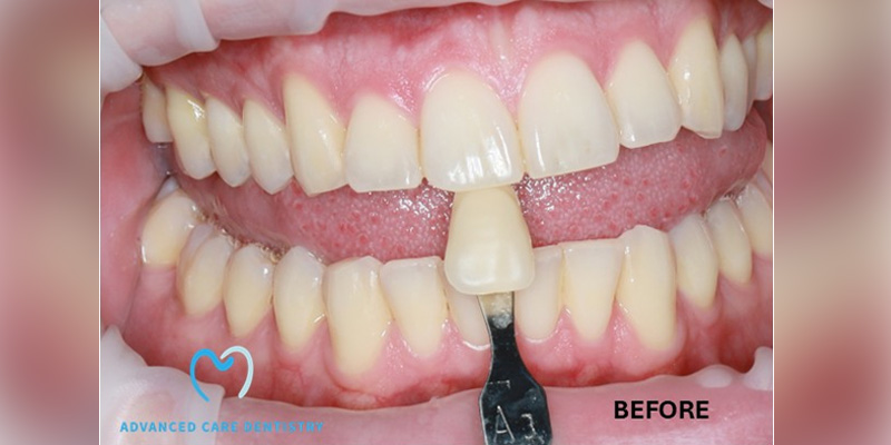 Close-up of teeth with a shade guide for dental color matching.