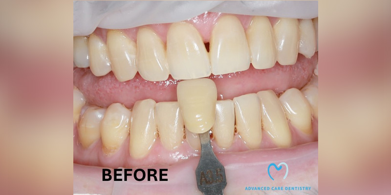 Close-up of teeth with a shade guide for dental color matching.