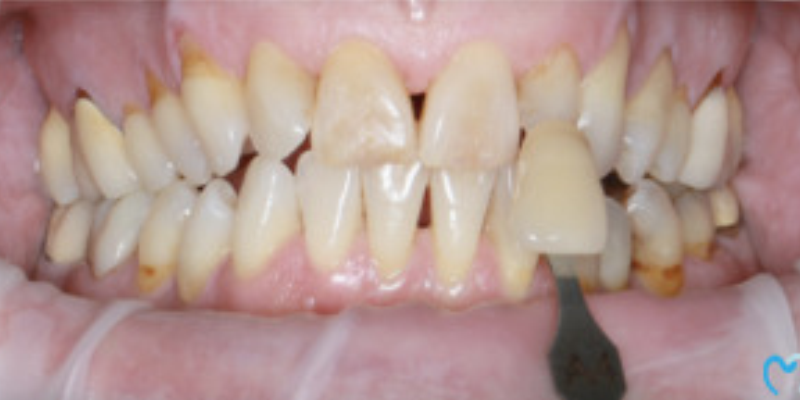 Close-up of teeth showing plaque and gum inflammation.