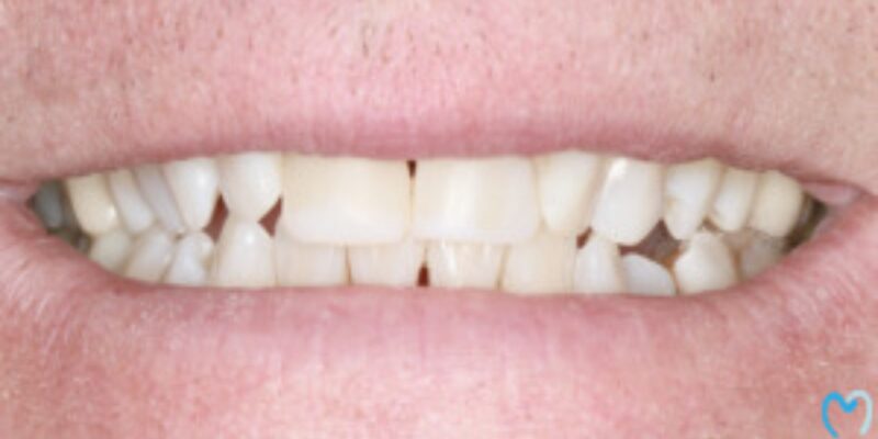 Close-up of teeth with a noticeable gap between the front teeth.