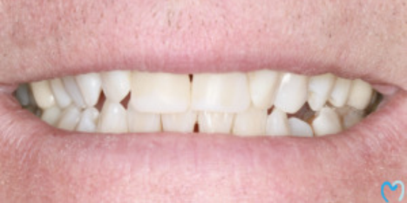 Close-up of teeth with a noticeable gap between the front teeth.