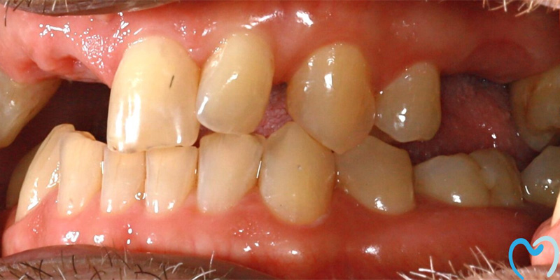 Close-up of human teeth showing dental crowding.