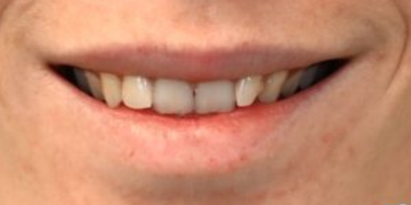 Close-up of a smile showing teeth with slight gaps.