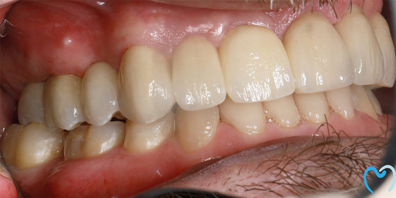 Close-up of a person's upper and lower teeth with dental restorations.