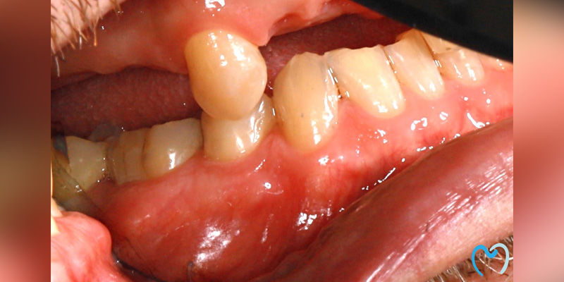 Close-up of gum inflammation around teeth with a dental bridge.