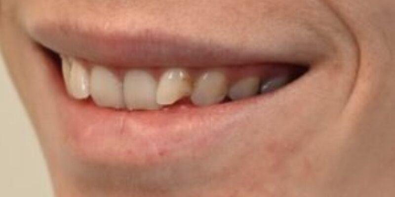 Close-up of a smile showing a chipped front tooth.
