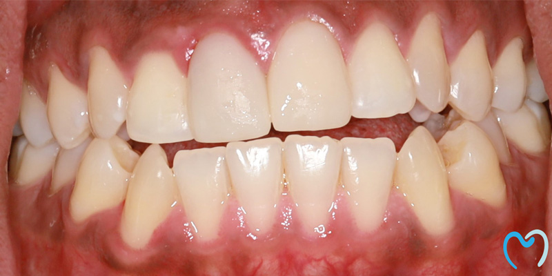 Close-up of teeth showing mild crowding and gum inflammation.