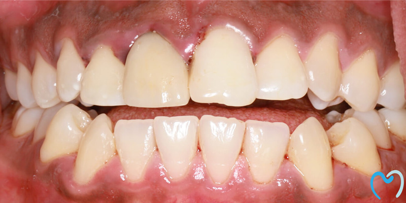 Close-up of teeth with visible dental issues.