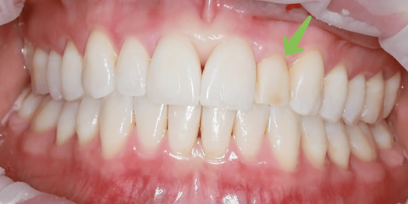 Close-up of teeth showing gum inflammation near an upper tooth.